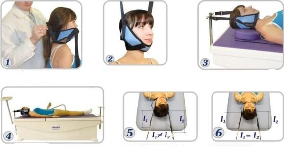 Traitement de l'ostéochondrose cervicale avec élimination