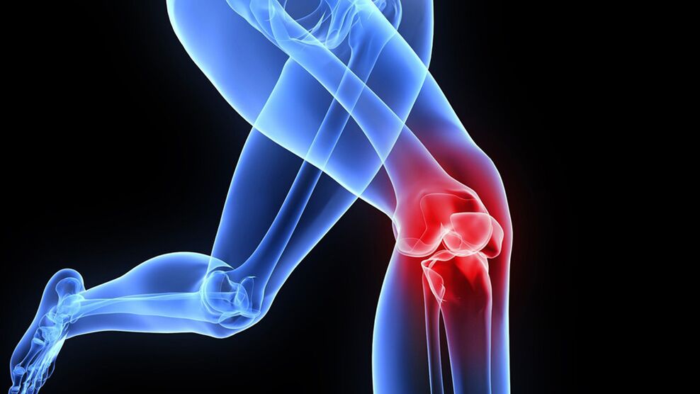 Problèmes de genou dus à l'arthrose