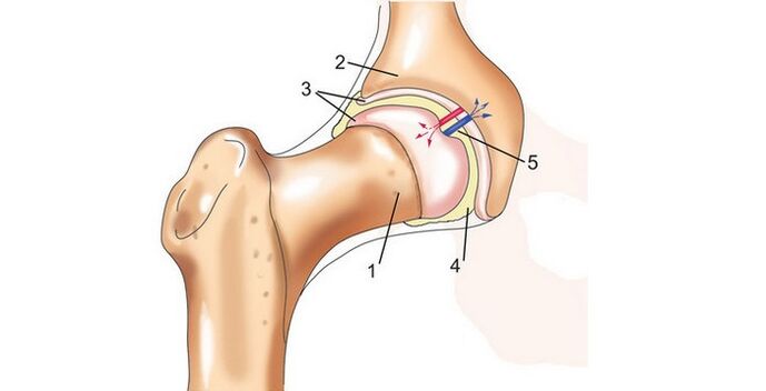 Articulation de la hanche et arthrose